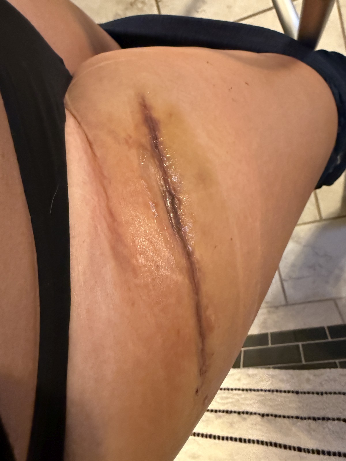 my right hip replacement incision